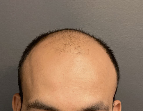 FUE hair transplant before